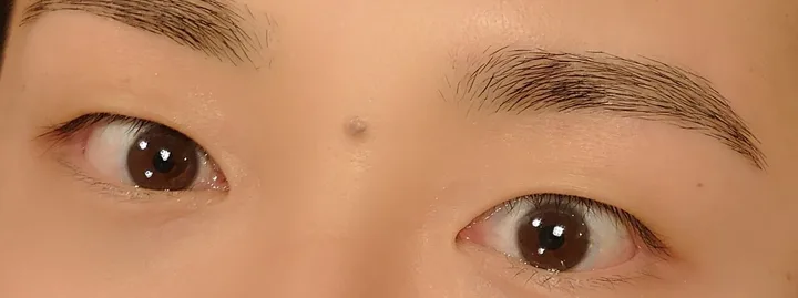 施術後の眉